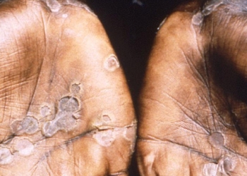 Symptoms are similar to those seen, in the past, in smallpox patients, but it is clinically less severe