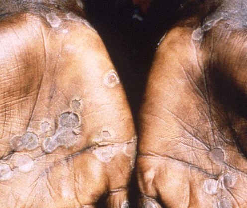Symptoms are similar to those seen, in the past, in smallpox patients, but it is clinically less severe