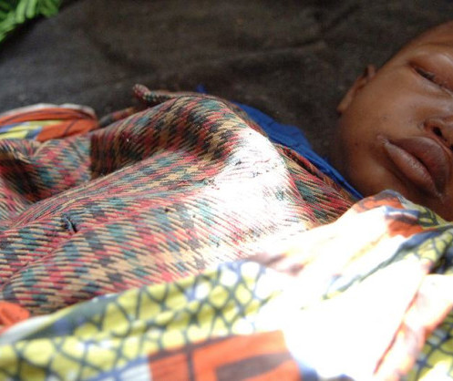 A five-year-old boy suffering from monkeypox rests in a health centre in a displaced camp in North Kivu, Democratic Republic of the Congo. Image source: UNICEF/Piero Pomponi