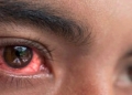 A patient suffering from Conjunctivitis.( Courtesy photo)